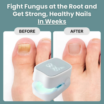 Zenorw Pro™ - Nail Fungus Laser Device