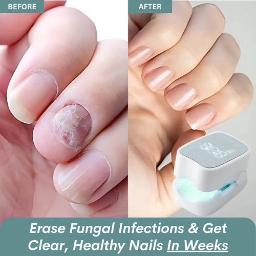 Zenorw Pro™ - Nail Fungus Laser Device