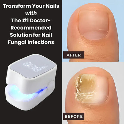 Zenorw Pro™ - Nail Fungus Laser Device